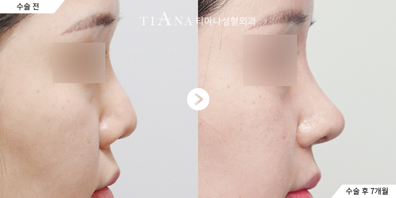 TIANA 隆鼻術前術後案例，鼻頭角度與側面比例的變化