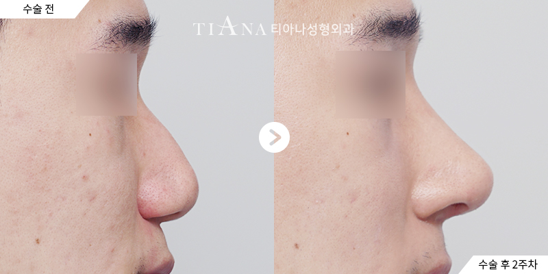 TIANA 隆鼻術前術後案例,全鼻整形後鼻樑與鼻頭的整體比例