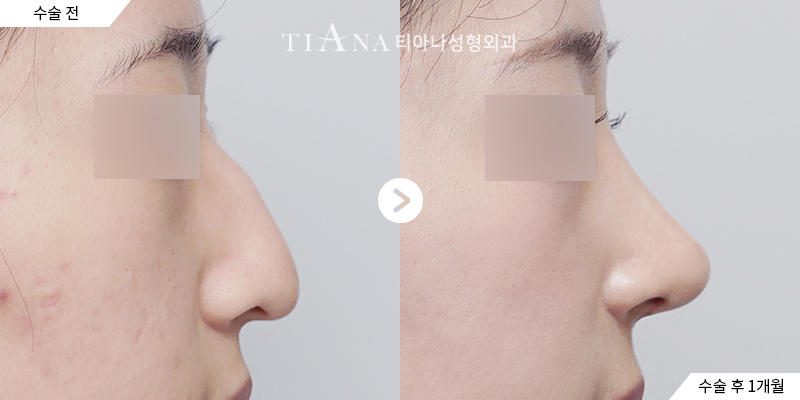 TIANA 隆鼻術前術後案例,鼻頭支撐與側臉線條的變化