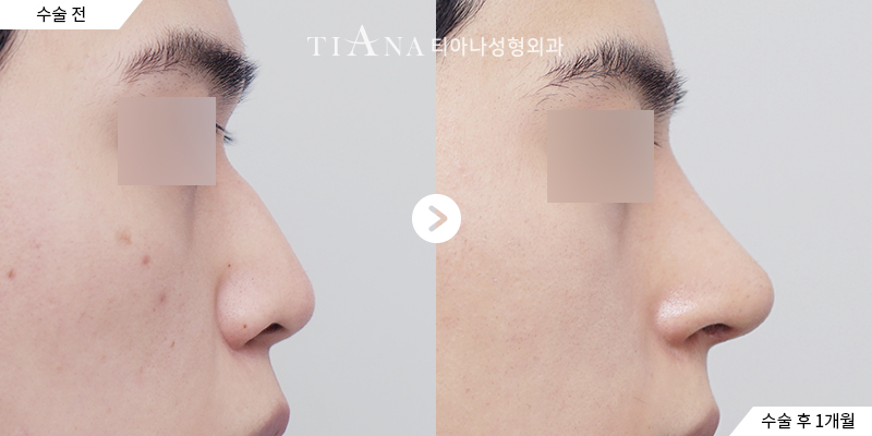 TIANA 隆鼻術前術後案例，消腫後鼻樑與鼻頭的比例