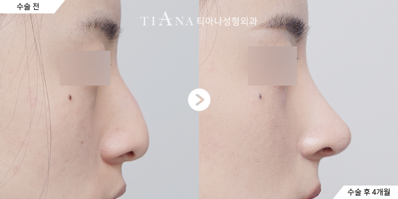 TIANA 隆鼻術前術後案例,恢復後側臉線條自然