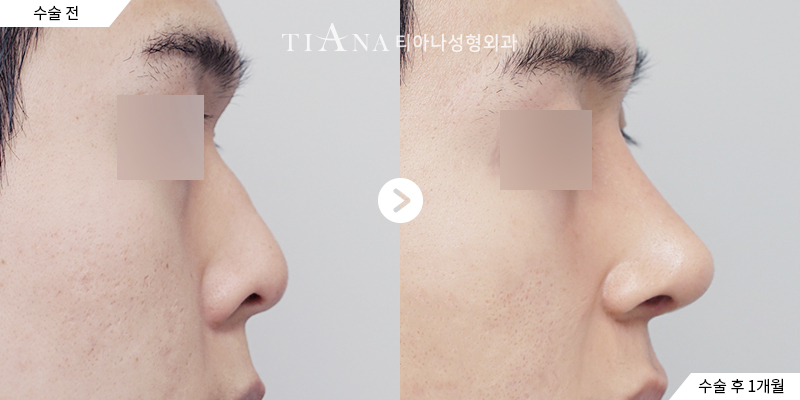 TIANA 隆鼻術前術後案例，鼻頭與眉間到鼻樑的線條