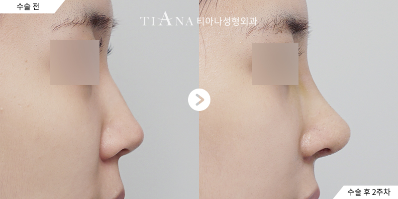 TIANA 隆鼻術前術後案例，側臉的鼻樑與鼻頭線條