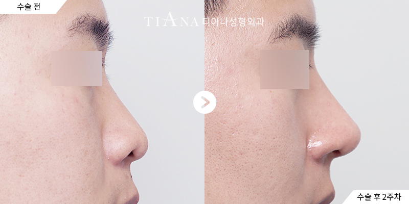 TIANA 隆鼻術前術後案例,恢復期間依個人狀況調整行程