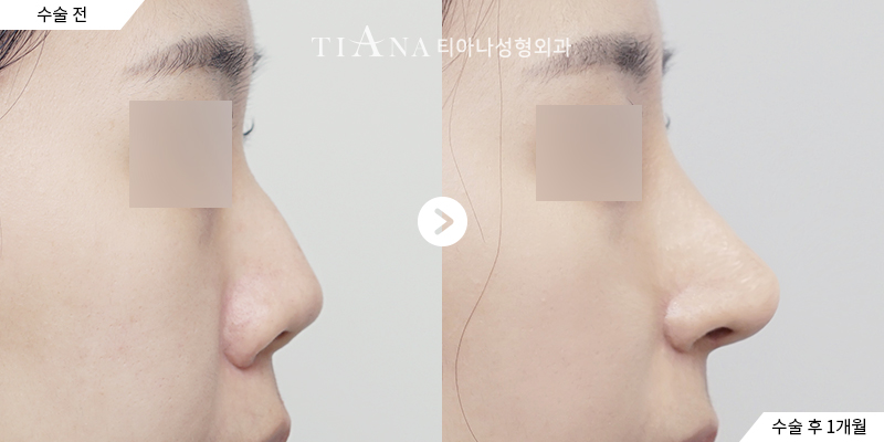 TIANA 隆鼻術前術後案例,修復手術後的鼻頭長度與角度