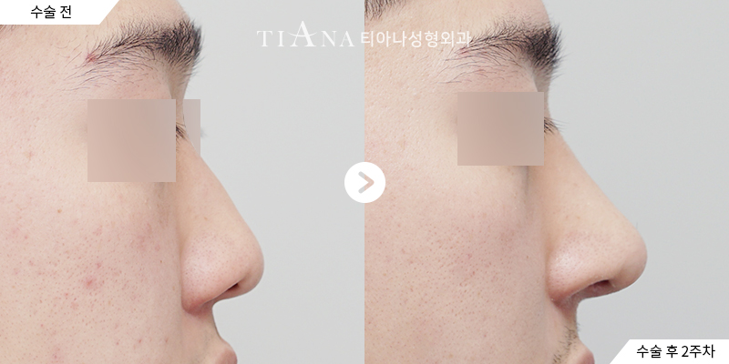 TIANA 隆鼻術前術後案例，鼻頭角度與側面比例的變化