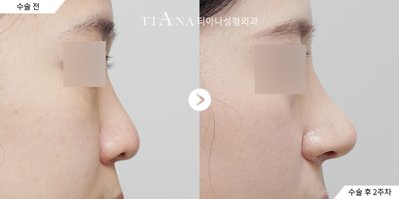 TIANA 隆鼻術前術後案例,鼻頭支撐與長度的調整
