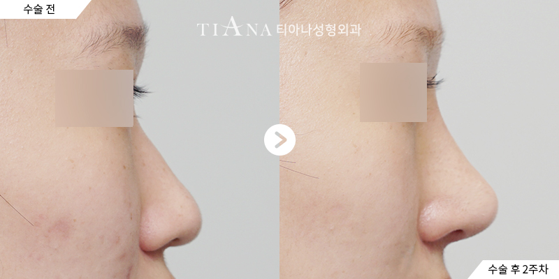 TIANA 隆鼻術前術後案例,鼻樑與鼻頭的整體比例