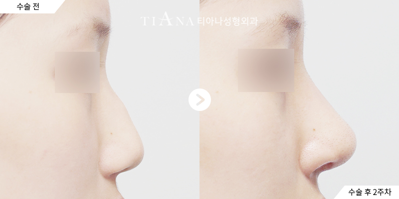 TIANA 鷹勾鼻隆鼻術前術後案例,側面駝峰修整後的線條