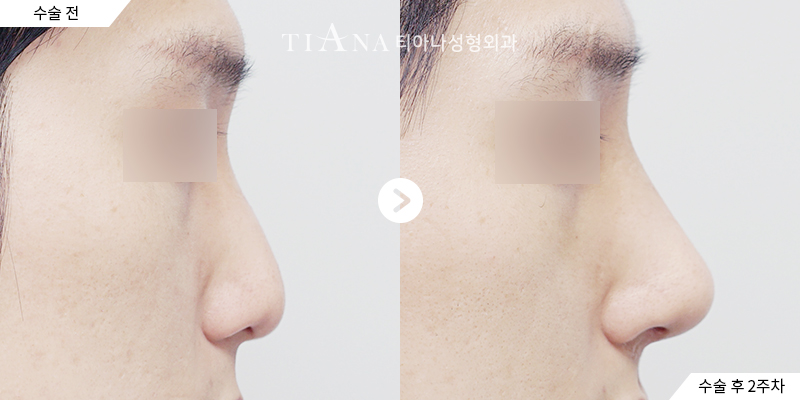 TIANA 隆鼻術前術後案例,側臉的鼻樑與鼻頭角度