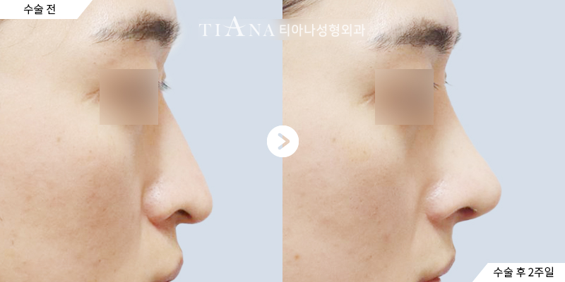 Side profile before and two weeks after rhinoplasty