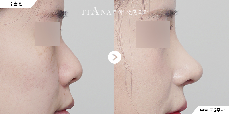 TIANA 隆鼻術前術後案例,側面鼻樑更流暢且鼻頭角度自然