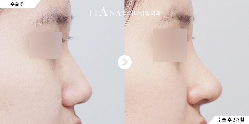 TIANA 隆鼻術前術後案例,恢復期後鼻樑與鼻頭的自然比例