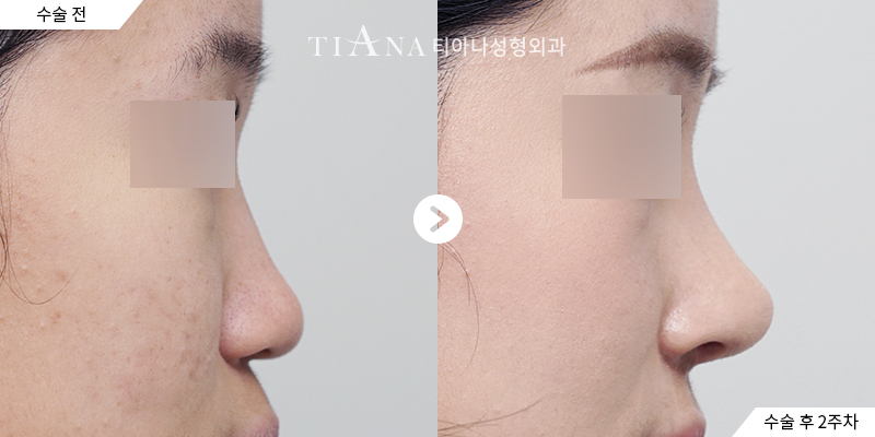 TIANA 隆鼻術前術後案例,鼻樑更挺、鼻頭更俐落但看起來依然自然