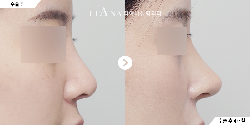 Side profile before and four months after tip surgery