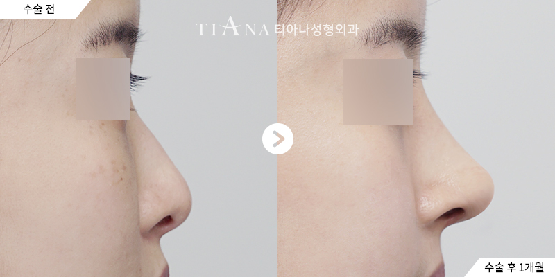 TIANA 隆鼻術前術後案例,消腫穩定後的側面外觀