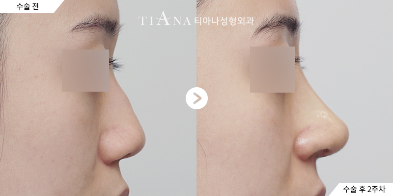 TIANA 隆鼻術前術後案例,鼻頭角度與側臉比例的調整