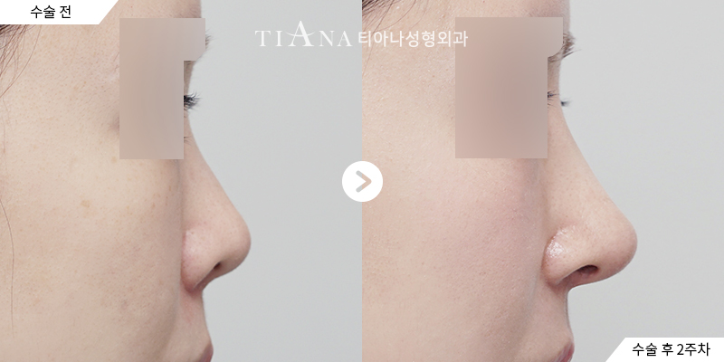 Side profile before and two weeks after tip lengthening