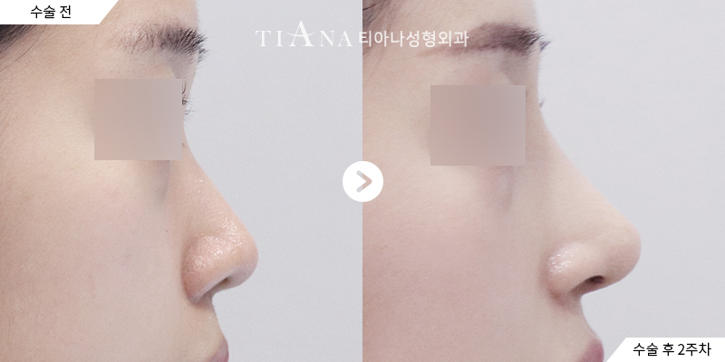 Side profile before and two weeks after nose tip refinement