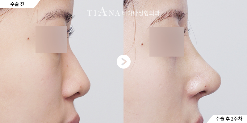 TIANA 隆鼻修復術前術後案例,調整後的側面線條