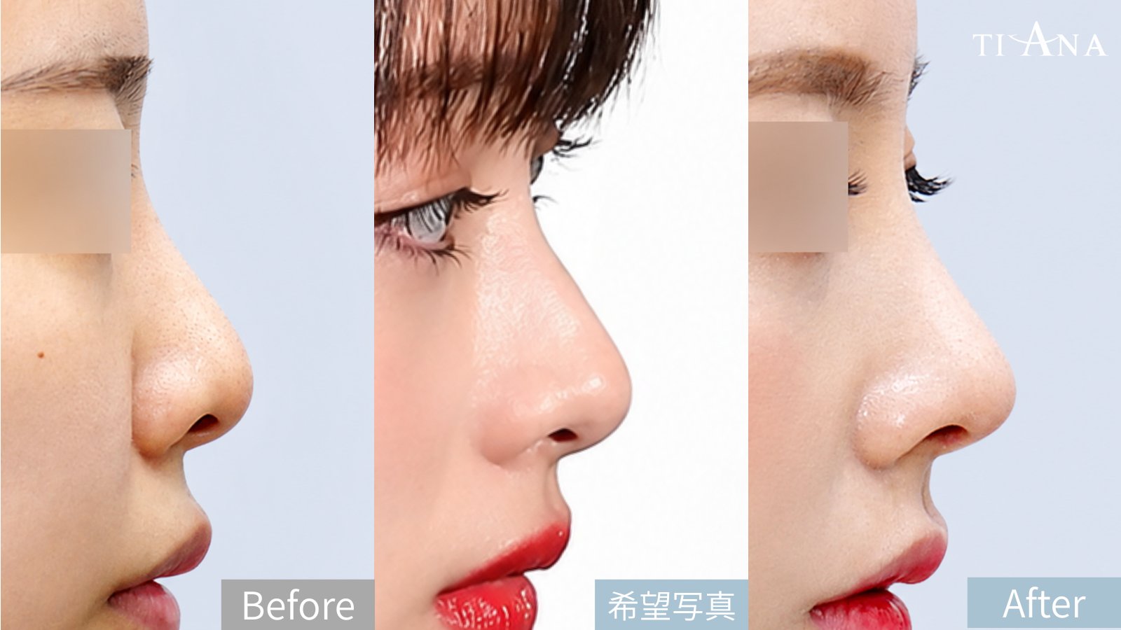 Before → 希望写真 → After — 韓国 鼻整形