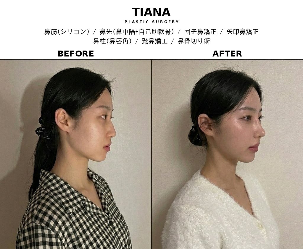 ティアナの鼻整形メニュー — 鼻筋・鼻先・団子鼻矯正・鷲鼻・骨切り