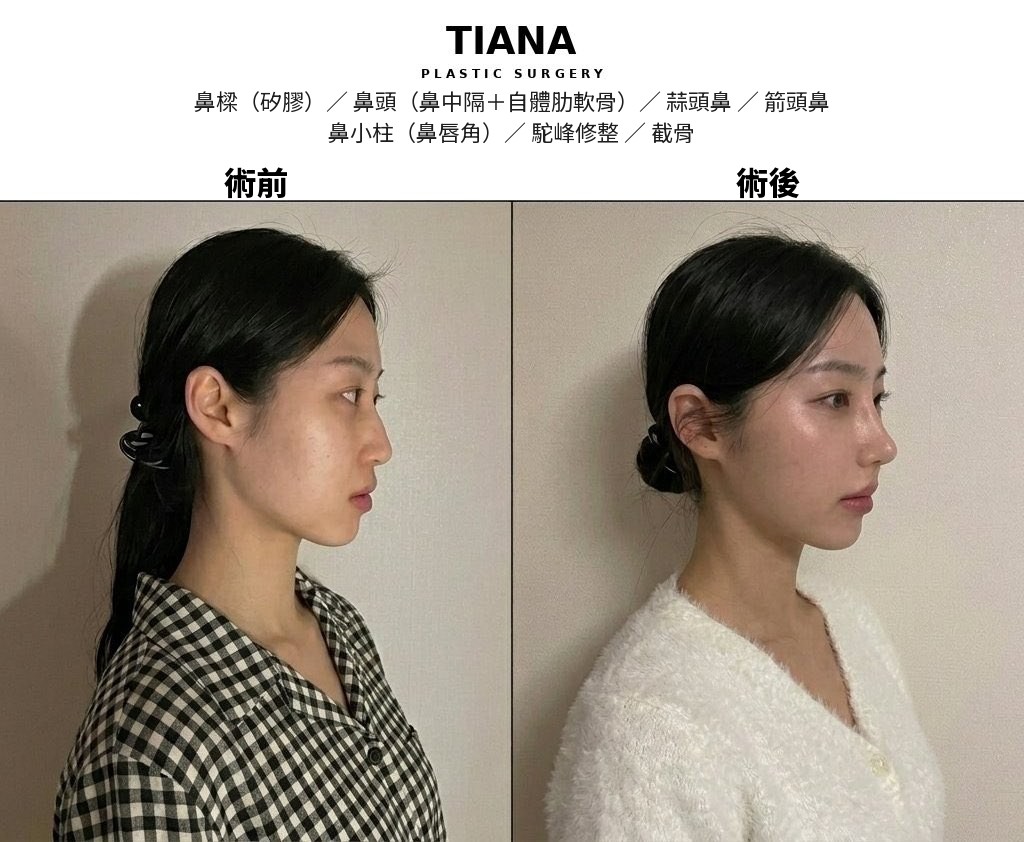 TIANA 全鼻整形術前術後案例,鼻樑與鼻頭的整體比例